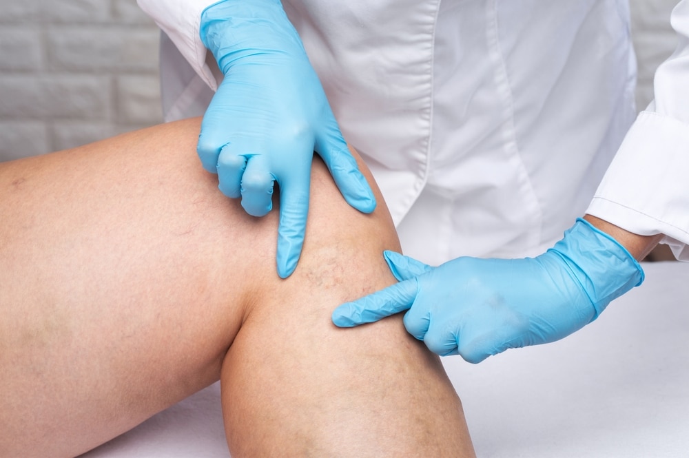 Removal,Of,Varicose,Veins,On,The,Legs.,Medical,Inspection,And Laser Vein Therapy in Sugar Land, TX