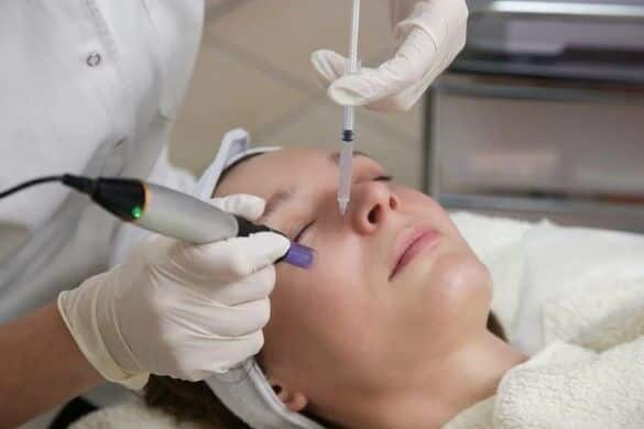 Comparing Traditional Microneedling With Secret Rf