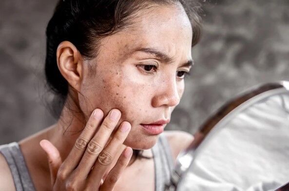Acne Scars