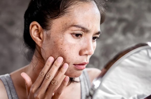 Acne Scars