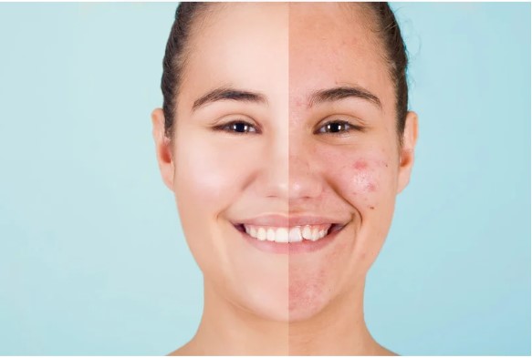 Aviclear Acne Treatment