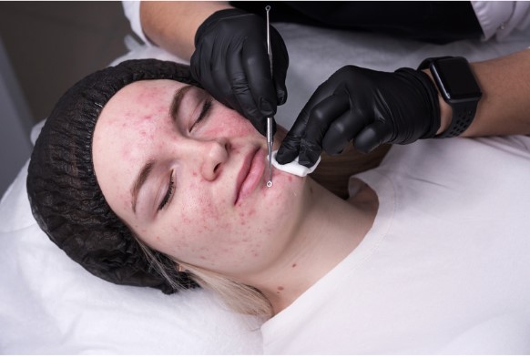 Laser Technology Work To Treat Acne2