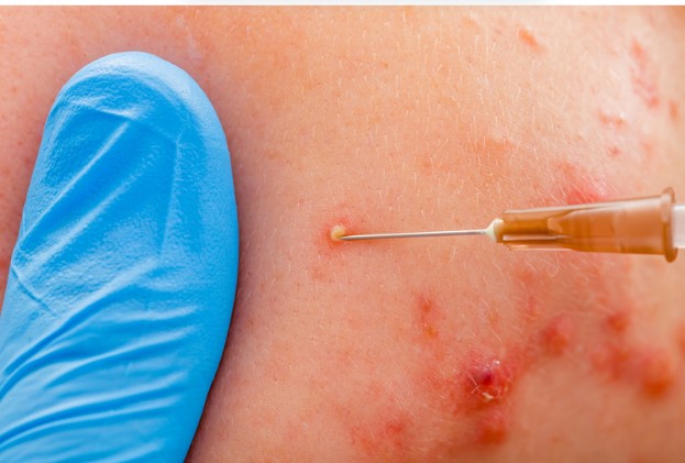 Patients Prefer Aviclear For Their Acne Treatment Journey